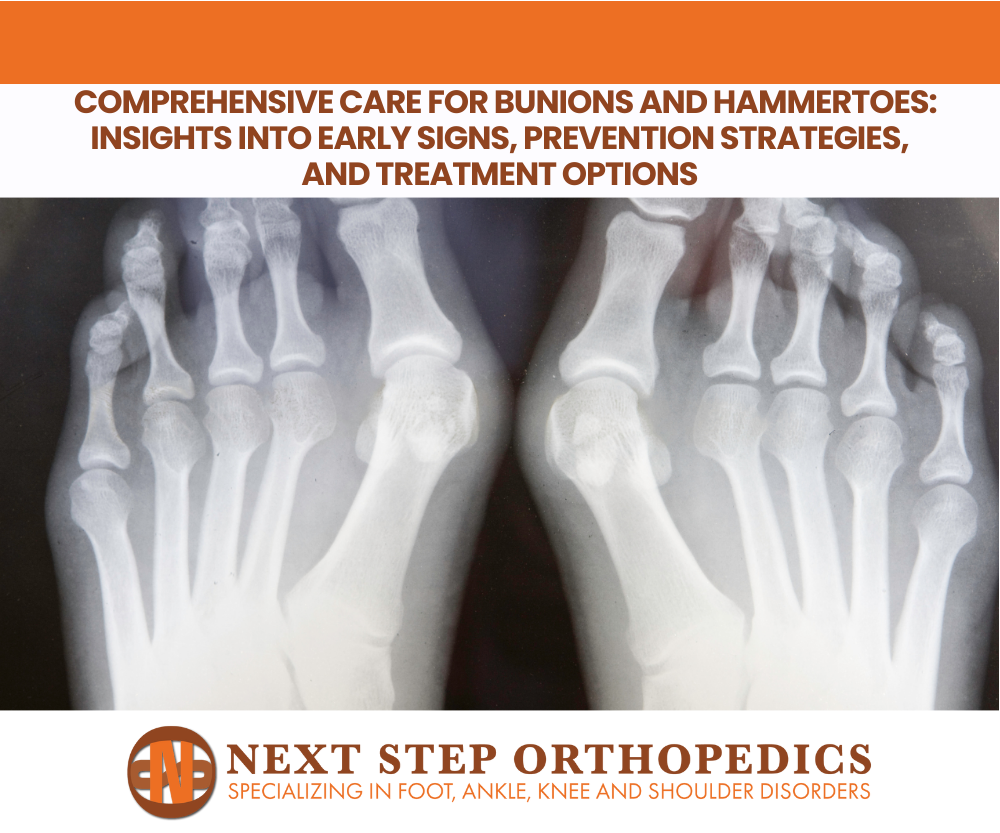 Comprehensive Care for Bunions and Hammertoes Insights into Early Signs, Prevention Strategies, and Treatment Options